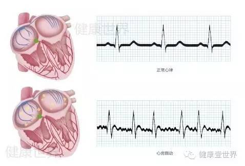 关于房颤的表现,浅谈房颤的病因