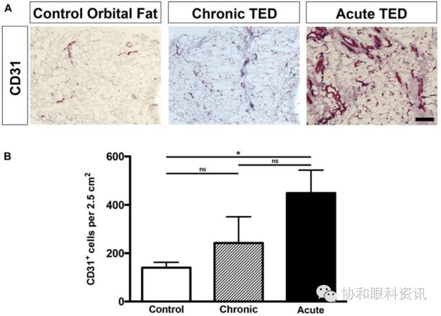 文摘速递TAO眶压升高,谁是幕后元凶?