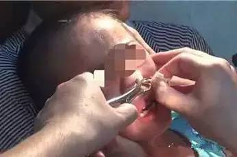 小孩鼻子痒最简单的自愈方法,3岁孩子鼻子痒会流血是怎么回事