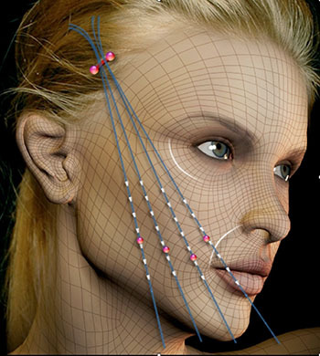 面部线雕提升比传统拉皮手术好在哪？