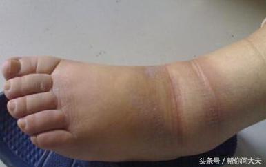 脚浮肿脸浮肿到底是什么原因,浮肿病是什么原因引起的