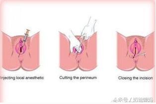 女人生孩子开几指才能顺产,生孩子骨缝开几指能生