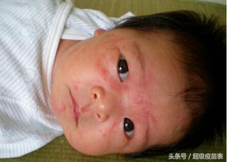 幼儿急疹高烧可以连续吃退烧药吗,幼儿急疹高烧期间心跳加速正常吗