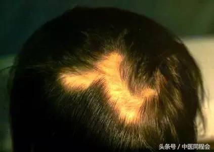 如何知道斑秃是什么病,请问斑秃怎么治疗效果最好最快