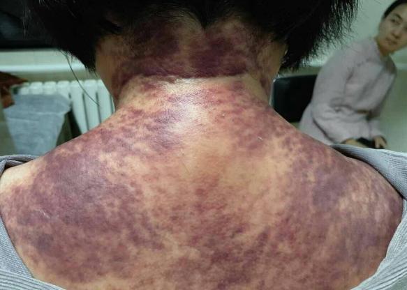 养生的刮痧穴位配图说明,中医养生10种刮痧方法刮走疾病