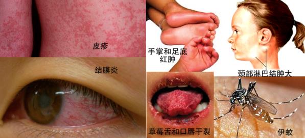 孕妇蚊虫叮咬用什么药安全,蚊虫叮咬孕妇注意事项