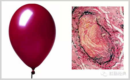 有趣痔疮的知识讲解,怪异的痔疮