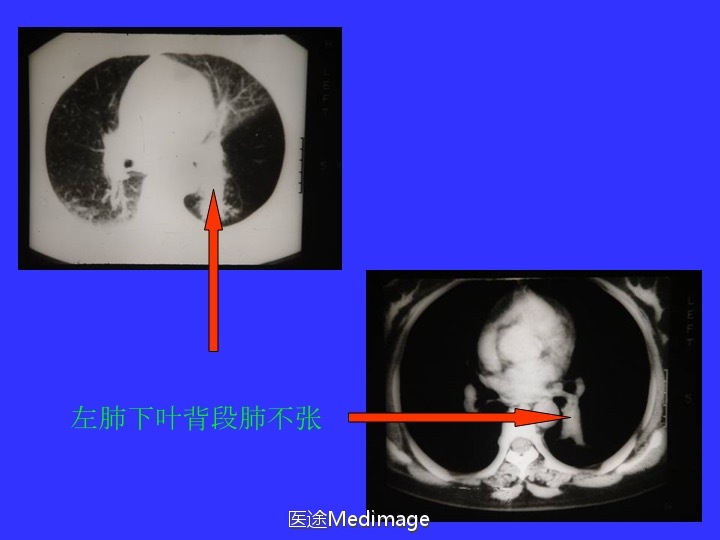 胸部ct扫描双肺未见明显异常,胸部ct报告心脏不大正常吗