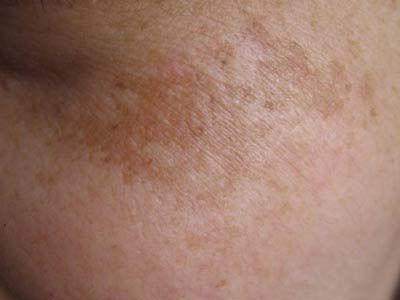 淡斑比较有效的方法,真正有效的淡斑方法
