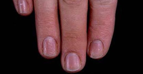 指甲的变化意味着身体的健康状况,当指甲发绿发脓的时候要怎么处理