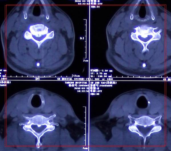 交感型颈椎病忌讳什么锻炼方法,交感型和椎动脉型颈椎病区别