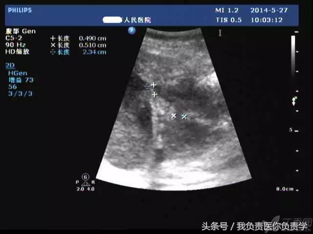 楂樻墜杩涢樁鑵拌吂璁粌,鑳嗗泭缁撶煶绌垮瓟鐥囩姸