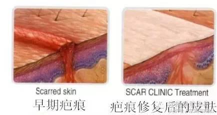 鼻子上的伤疤修复手术多少钱,修复1cm凹陷伤疤要多少钱