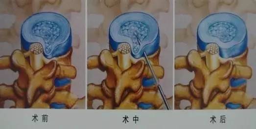射频等离子针刀价格,射频等离子针刀
