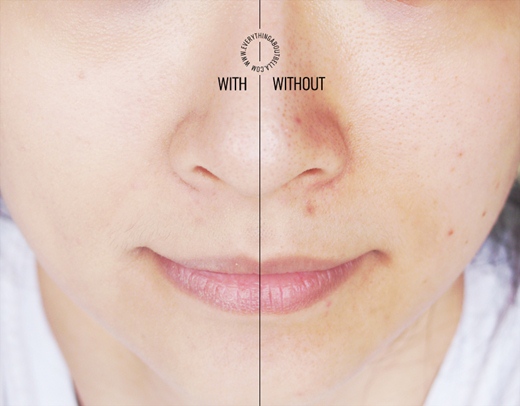 痘痘上遮瑕,粉刺性痘痘如何遮瑕