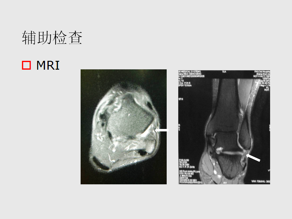 脚崴了怎么办判断是否骨折,脚崴了怎么办视频