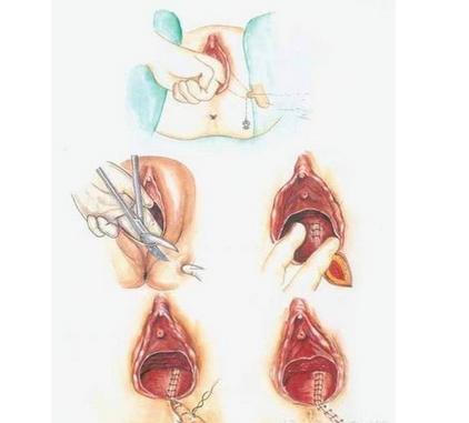 顺产侧切38天伤口疼正常吗,顺产妈妈肚子疼正常吗