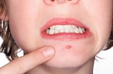 后背起红扁疙瘩还痒痒是什么原因,后背起大扁红色疙瘩怎么回事