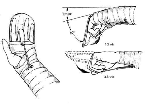 他手指上被切掉的肉跟鸭子肉一起煮了！手外伤怎么紧急处理？