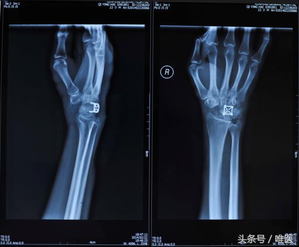 月骨舟骨半脱位手术,手腕舟骨月骨周围脱位要多久康复