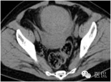 病例丨病理结果「医看」有奖阅片大赛病例资料8：右侧卵巢纤维瘤#医学影像#
