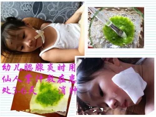 家长得了腮腺炎小孩如何预防,小孩流行性腮腺炎怎么预防