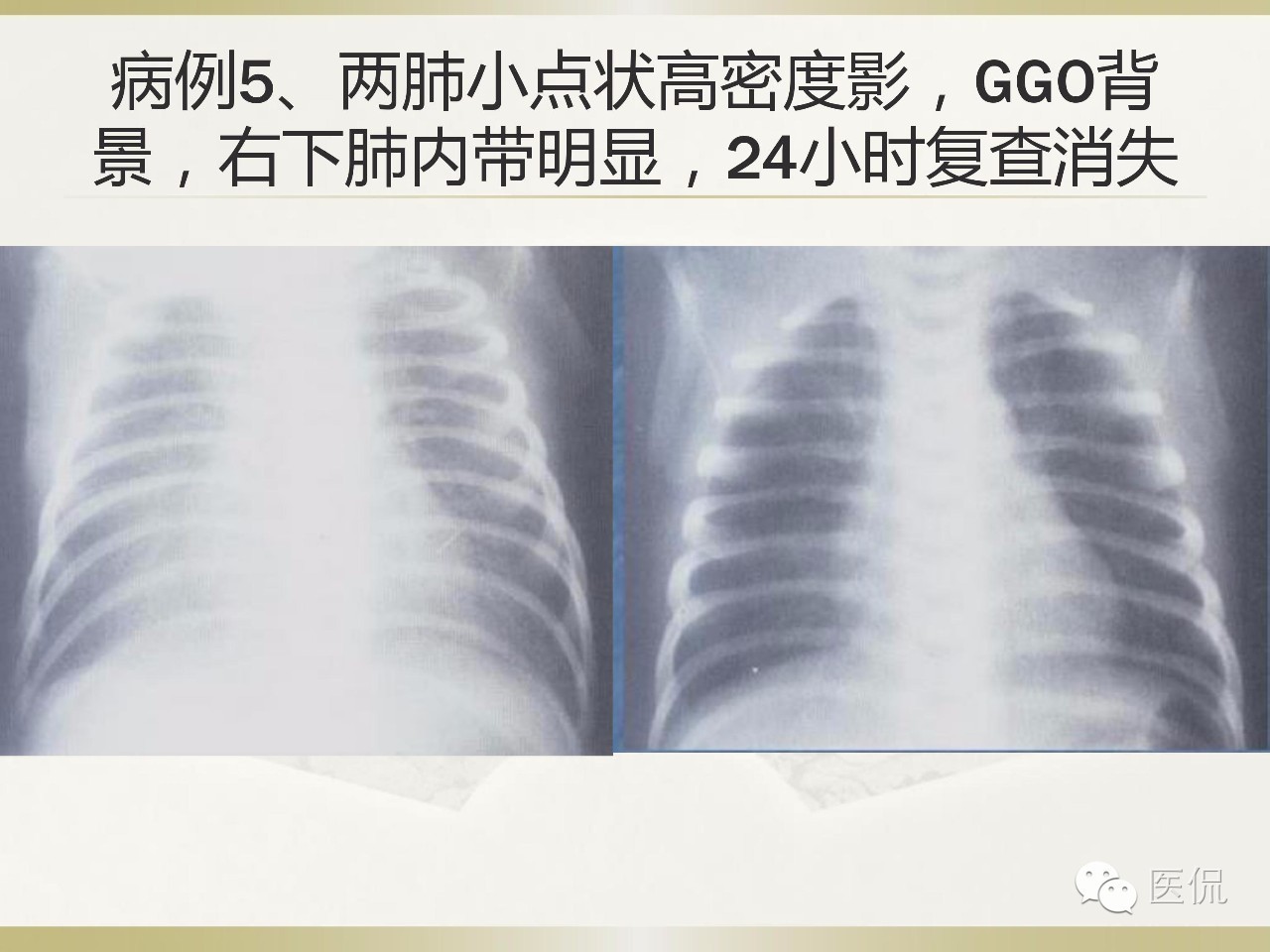 「资料丨医看分享」南边老师肺部群：新生儿透明膜病（HMD）医学影像