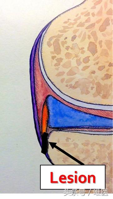 膝关节内侧后角半月板1度损伤,右膝关节内侧半月板后角变性损伤