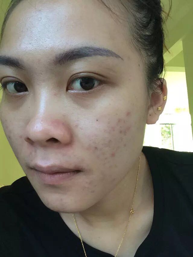 如何治疗闭口粉刺痘痘？教你一招