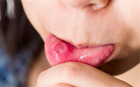 张仲景有哪些方子可以治口腔溃疡,用一种药治口腔溃疡