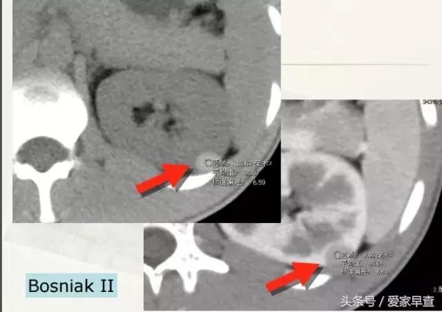 布什还是奥巴马？放射科杨大夫谈体检查出的结节和囊肿