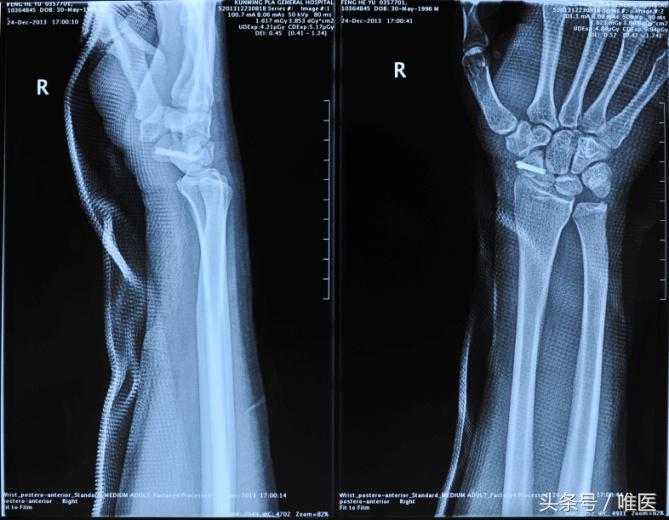 月骨舟骨半脱位手术,手腕舟骨月骨周围脱位要多久康复