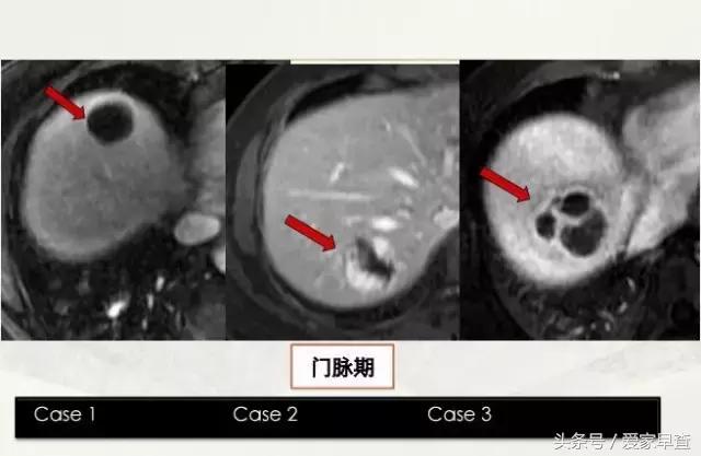 布什还是奥巴马？放射科杨大夫谈体检查出的结节和囊肿