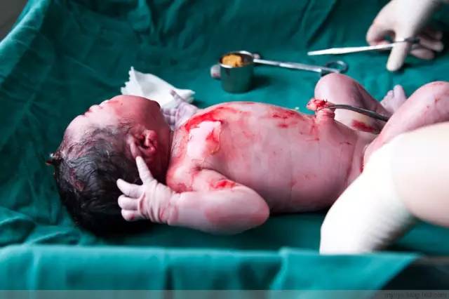 剖腹产恢复很好的照片,剖腹产完全恢复照片