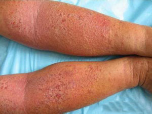 皮肤湿疹为什么这么难治愈,一定要从根源解决皮肤湿疹问题