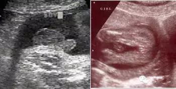 识别胎儿的办法,识别胎儿