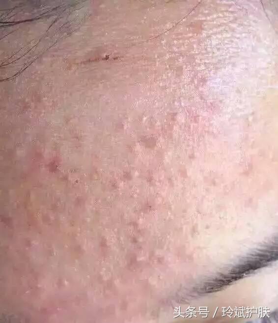 闭合性粉刺怎么去除额头,闭合性粉刺怎么去除