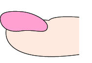 大拇指指甲出现纵纹凸出是什么病,指甲出现黑色的纵纹