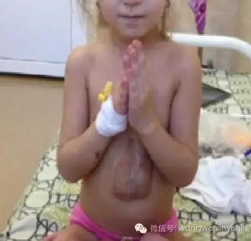 图与真相：什么是胸骨裂？