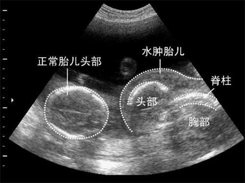 怀孕四个月b超显示5周,怀孕四个半月已经照了7次b超