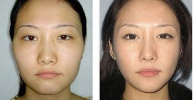 为什么玻尿酸丰唇没有任何效果,玻尿酸丰太阳穴有点压在眼皮