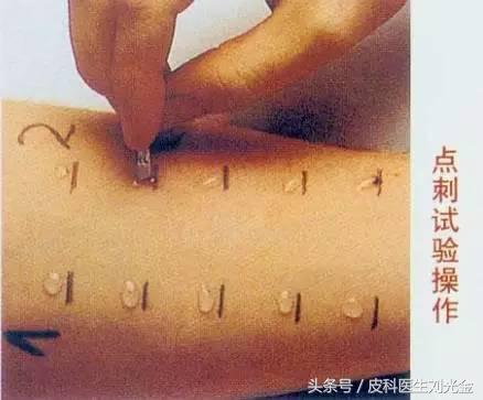 过敏原检测都能查出什么过敏原,查过敏原有哪种方法