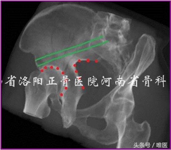 经皮置入术在骨盆髋臼骨折治疗中的应用骨医小灶第二十一期（中）
