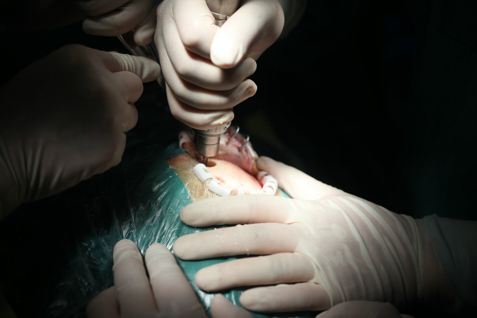 神经外科纪实视频,显微神经外科手术费用