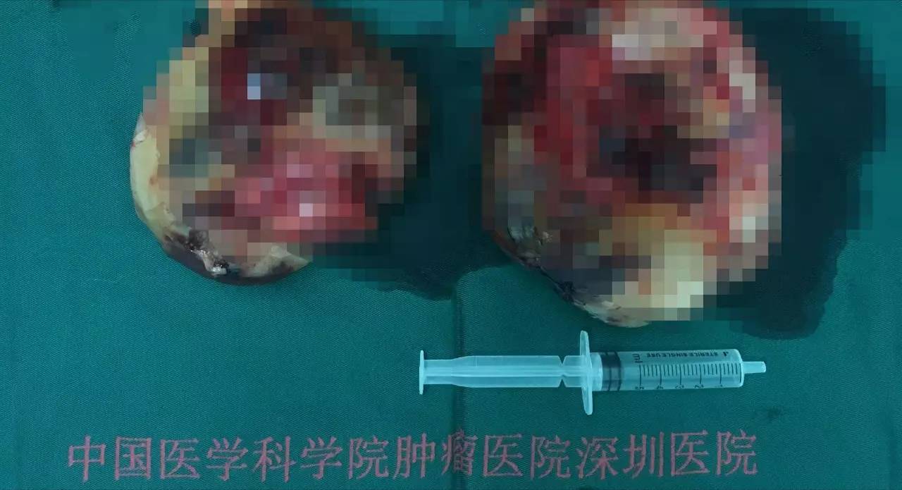 子宫没了有妇科疾病吗,子宫没有肿瘤可以排除宫颈癌吗