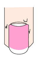 大拇指指甲出现纵纹凸出是什么病,指甲出现黑色的纵纹