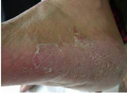 香港脚用什么快速治好,香港脚的最佳治疗方法泡脚