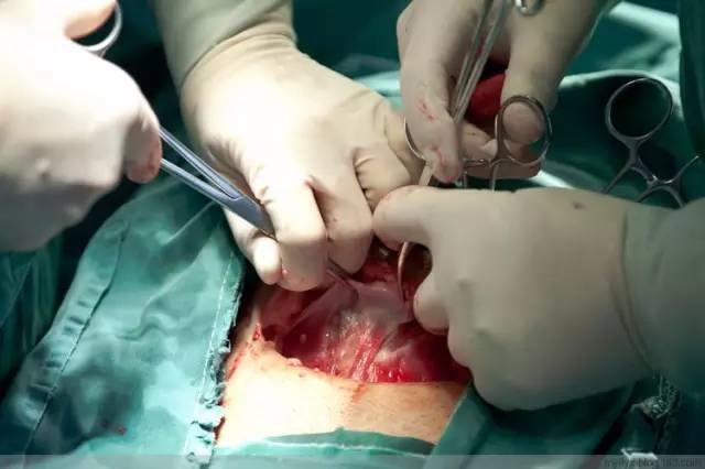 剖腹产恢复很好的照片,剖腹产完全恢复照片