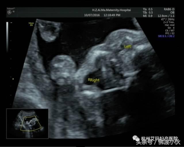 “借我，借我一双慧眼吧”——胎儿眼畸形