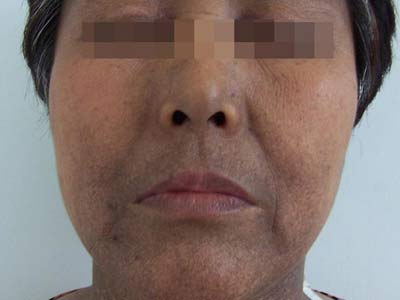 脸老感觉洗不干净,脸上的黑斑很多年了能去除吧